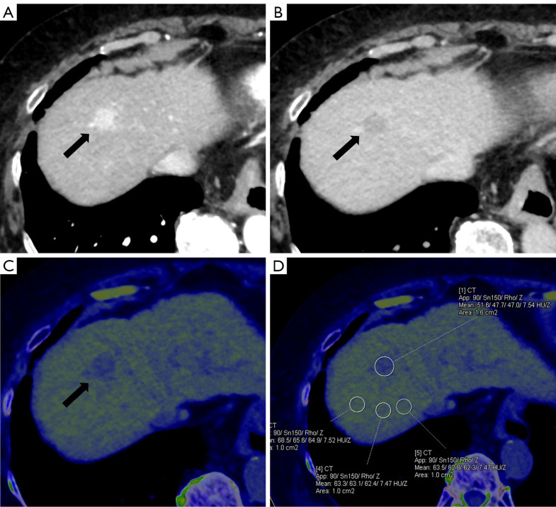 Dual-energy computed tomography-derived electron density in the differential diagnosis of focal hepatic lesions: initial experience.