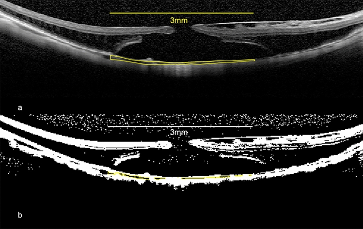 Choroidal changes after vitrectomy performed for macular hole retinal detachment.