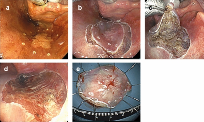 Treatment strategies and prognosis of superficial laryngo-pharyngeal cancer: a literature review.