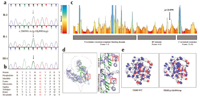 A Rare <i>TERT</i> Mutation Associated with Idiopathic Pulmonary Fibrosis and COPD in a Chinese Family.