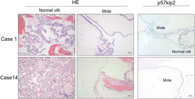 Outcomes of cases with complete hydatidiform mole coexisting with a fetus: a single-center study.