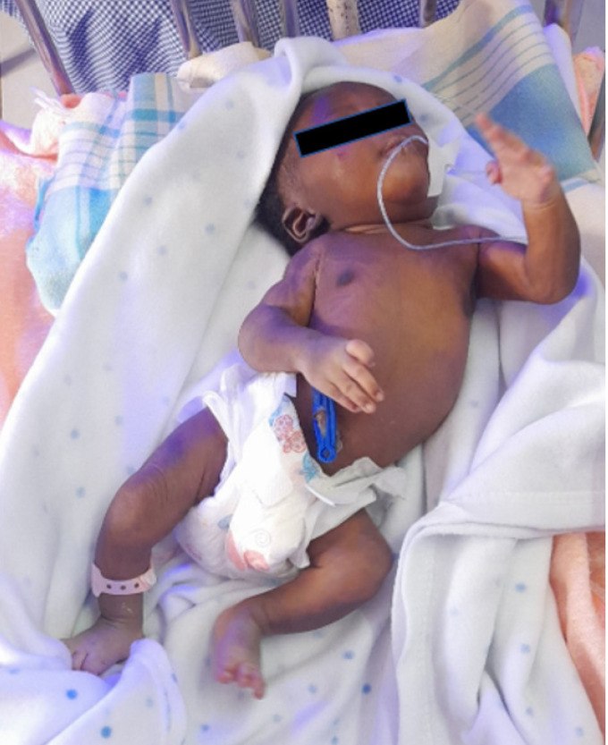 Congenital scoliosis with truncus arteriosus type 1 in a preterm neonate: A case report.