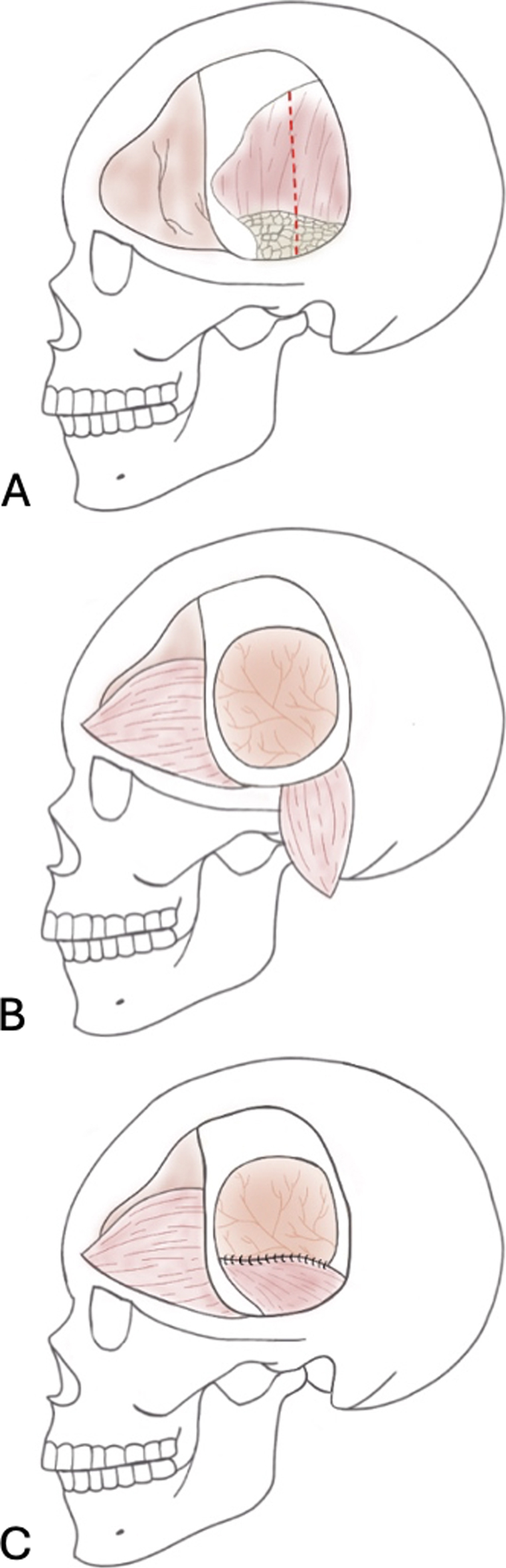 Upfront use of temporal myofascial flap for repair of traumatic injury and prevention of CSF leaks: illustrative cases.