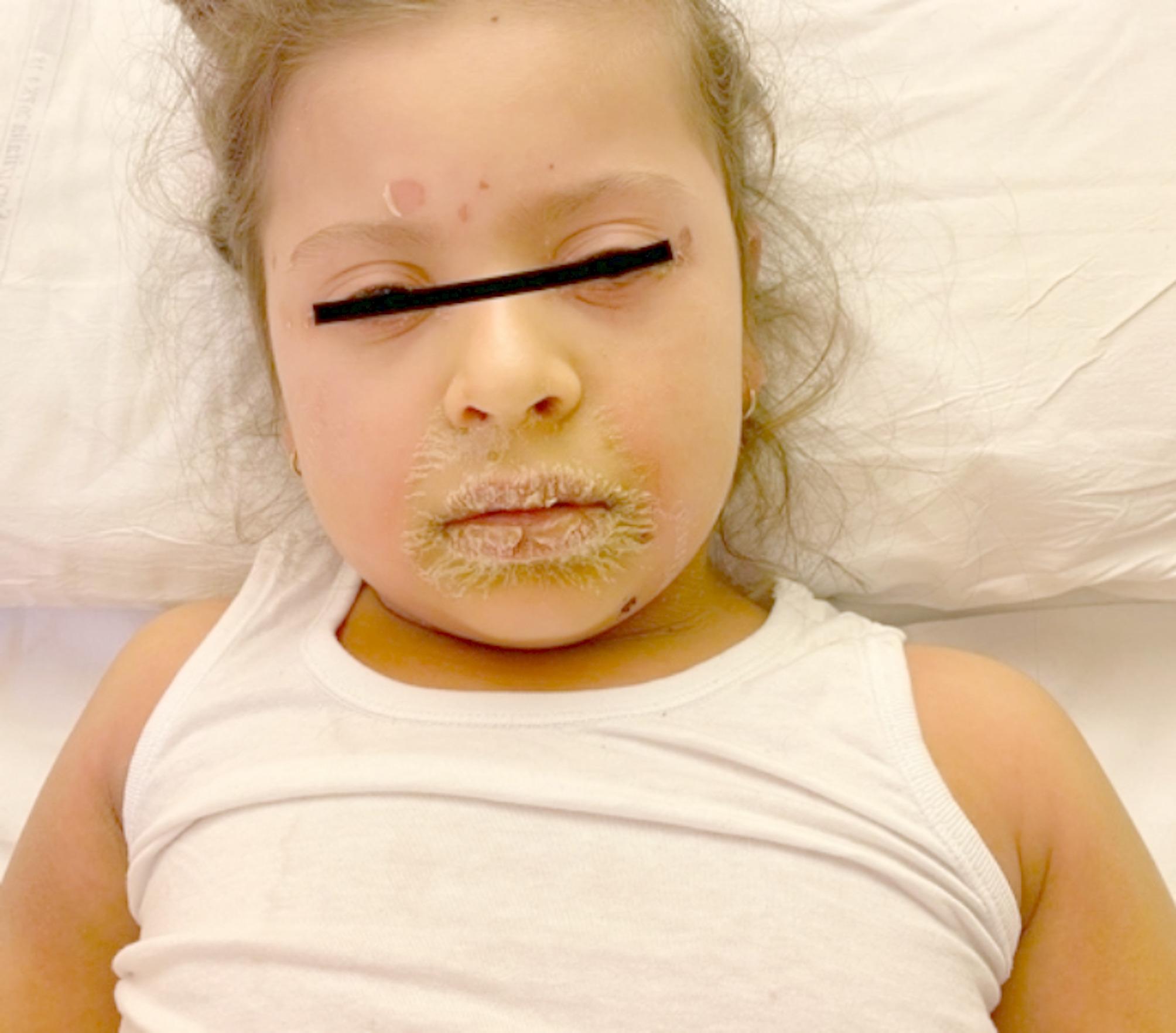 Staphylococcical scalded skin syndrome: a case series description of a rare and critical disease in a tertiary pediatric center.