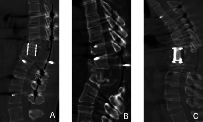Risk Factors for Poor Matching of Intervertebral Fusion Devices After Posterior Vertebral Column Resection in Patients With Kyphosis or Kyphoscoliosis.