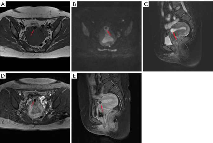 Diagnostic and clinical value of multiparameter magnetic resonance imaging in cesarean scar pregnancy: a comparative study of sequence combinations.