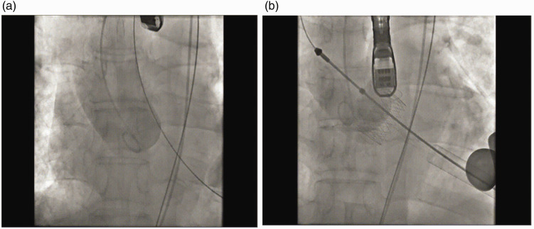 Transcatheter aortic valve implantation in a patient with isolated aortic regurgitation using JenaValve.