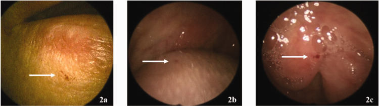 Epistaxis due to hereditary hemorrhagic telangiectasia: A case report and literature review.