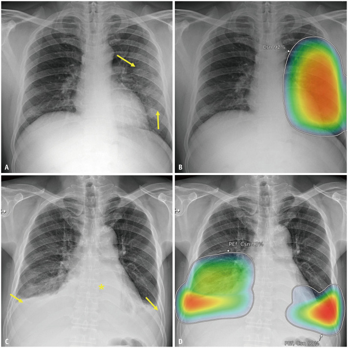 Artificial Intelligence Analysis of Chest Radiographs for Predicting Major Adverse Events in Patients Visiting the Emergency Department With Acute Cardiopulmonary Symptoms.