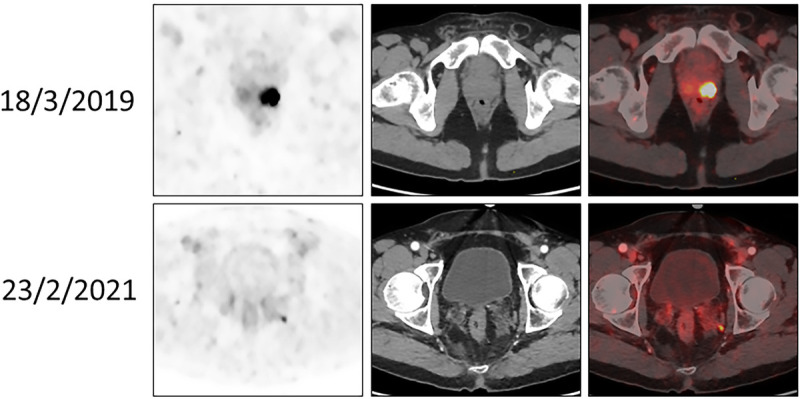 The relevance of nomograms for prediction of pelvic lymph node metastases in the prostate-specific membrane antigen (PSMA)-PET/CT era.