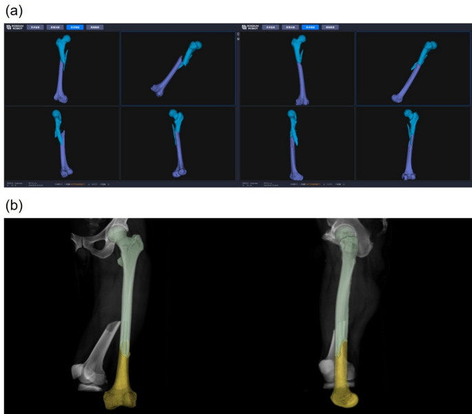 Robot-assisted closed reduction of femoral shaft fractures: a prospective controlled study.