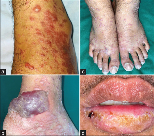 Lichen Planus Pemphigoides: A Clinical, Histopathological, and Immunological Report of 12 Indian Patients.