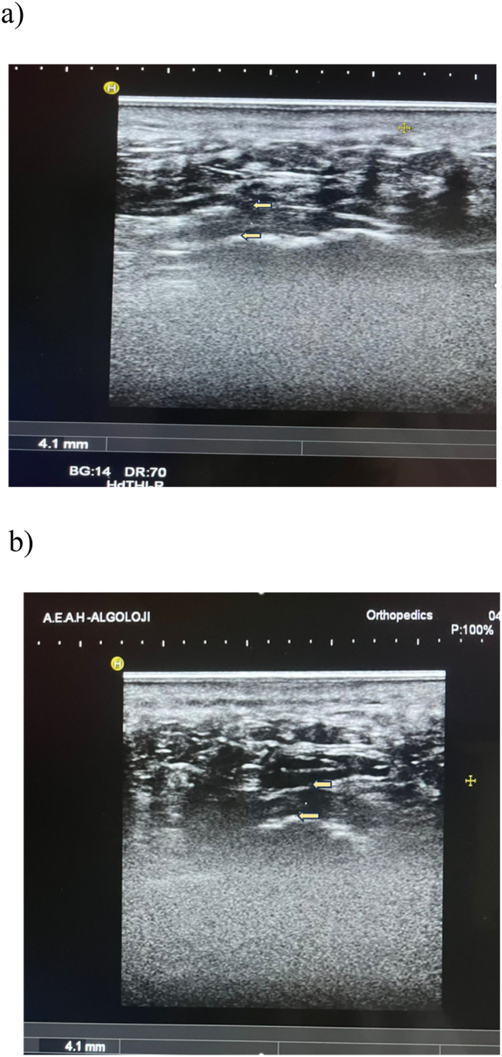 Comparative Effectiveness of Ultrasound-Guided Corticosteroid Injection, Radiofrequency Ablation, and Their Combination for Recalcitrant Plantar Fasciitis: A Retrospective Cohort Study.