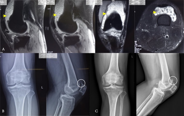 Efficacy Analysis of Arthroscopic Treatment of Synovial Chondromatosis of the Knee: A Retrospective Study of More Than Five Years.