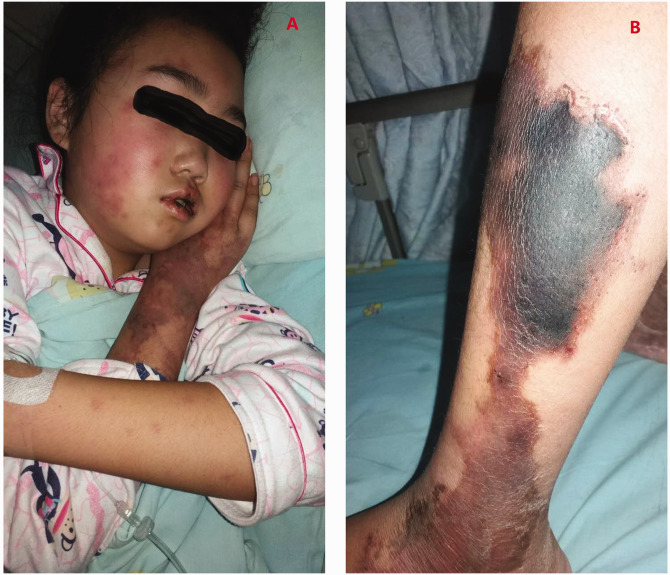 Recurrent single-organ cutaneous small-vessel vasculitis with streptococcal infection in a pediatric patient: A case report.