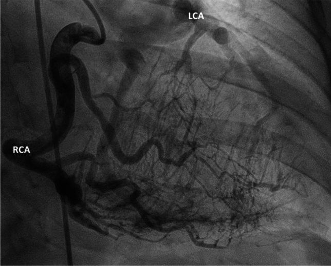 A 39-year-old women with newly diagnosed ALCAPA syndrome during pregnancy.