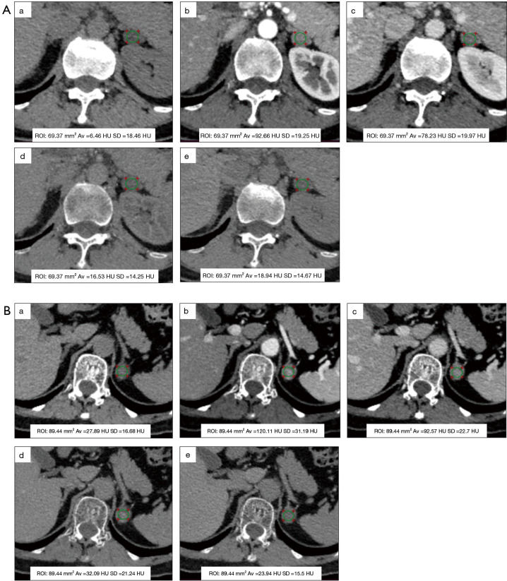 Dual-layer spectral detector computed tomography for adrenal adenoma characterization: radiation dose reduction and quantitative agreement of multiphase virtual noncontrast with true noncontrast imaging.