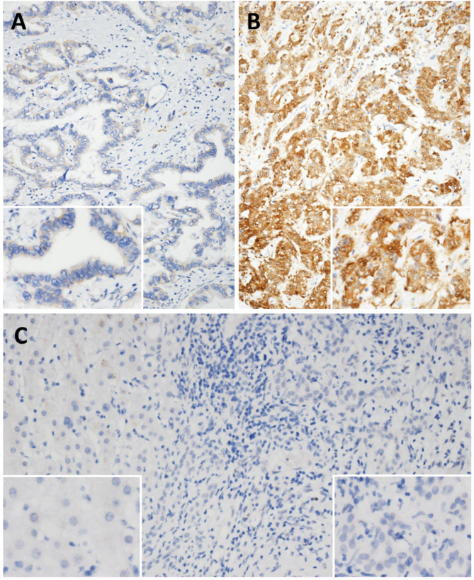 Prognostic impact of RPL15 overexpression in intrahepatic cholangiocarcinoma: a marker of aggressive tumor behavior.