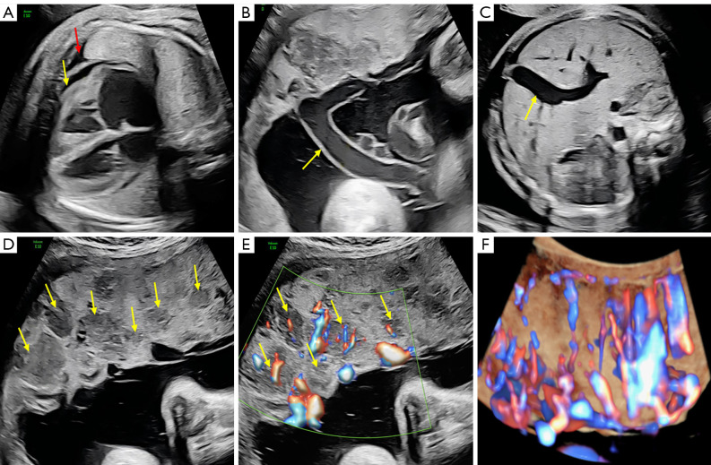Prenatal ultrasound diagnosis of a rare diffuse placental chorioangioma with fetal edema: a case description and prognostic analysis.