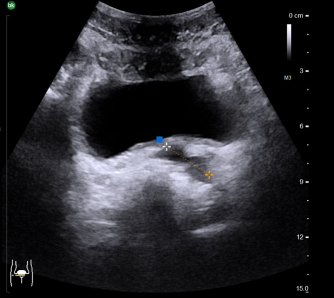 [Occlusive azoospermia in unilateral cystic alteration of the seminal vesicle and contralateral seminal vesicle agenesis-case report].