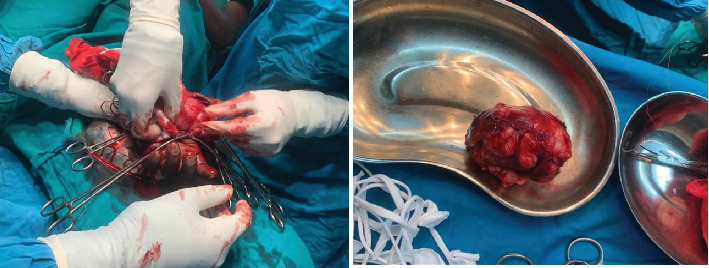 Synovial Sarcoma: Malignant Soft Tissue Sarcoma With Benign Clinical Characteristics-A Case Report.