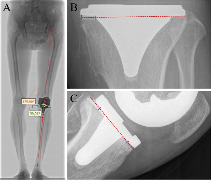 Risk Factors for Physiologic Radiolucent Lines Under the Tibial Base Plate After Osteoarthritis With Primary Computer-Assisted Navigation TKA-A Nested Case-Control Study.