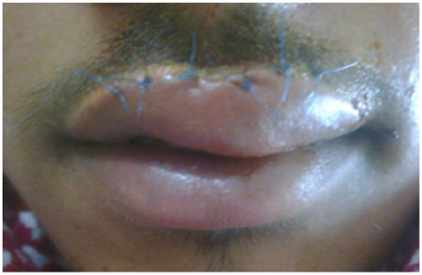 Beyond Sutures: Moist Exposed Burn Ointment (MEBO) and Scar Massage for Anatomical Restoration of Penetrating Upper Lip Laceration at the Vermilion-Cutaneous Junction in Primary Care-A Case Report.