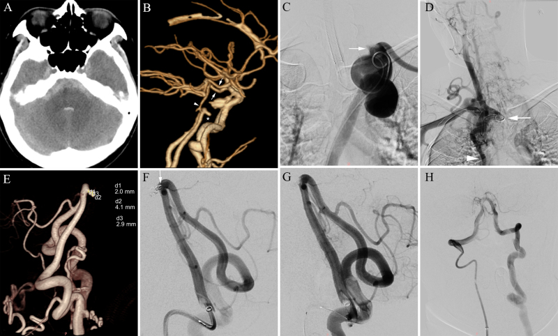 Ruptured vertebrobasilar junction aneurysm coexisting with isolated interrupted aortic arch and basilar artery hypoplasia in an adult female: illustrative case.