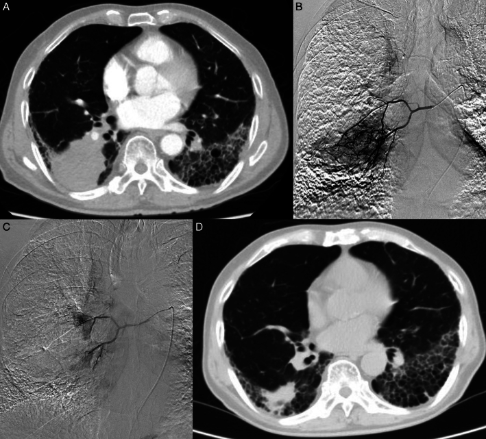 Bronchial Arterial Chemoembolization With Drug-eluting Beads Versus With Gelfoam Particles for Advanced Nonsmall-cell Lung Cancer.
