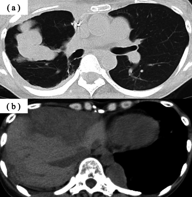 Pure Red Cell Aplasia That Developed 13 Years After Thymoma Treatment: A Case Report and Literature Review.