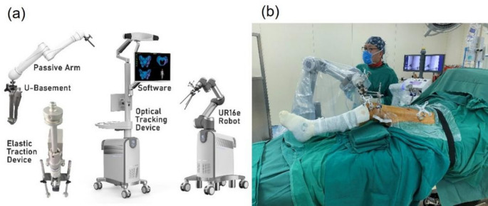 Robot-assisted closed reduction of femoral shaft fractures: a prospective controlled study.