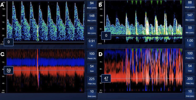 Transpulmonary bubble transit in patients hospitalised with COVID-19 pneumonia.