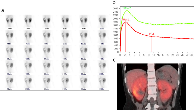 Imaging renal mitochondrial dysfunction in chronic kidney disease: a repurposed role for [<sup>99m</sup>Tc]Tc-MIBI SPECT/CT.