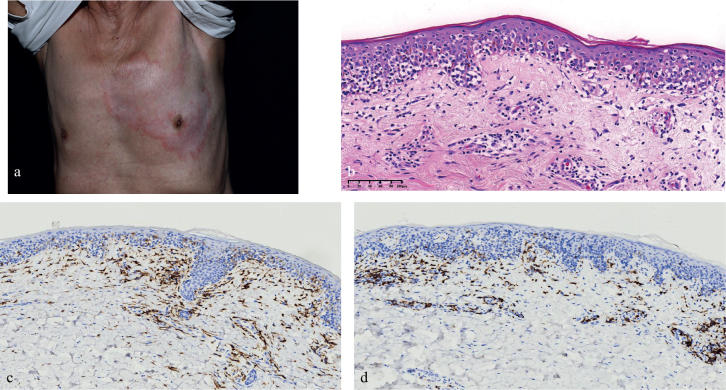 An Elderly Man with a Solitary Hypopigmented Annular Plaque on the Chest: A Quiz.