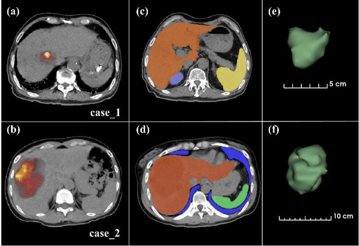 Optimizing dosimetry in Y-90 microsphere radioembolization: GPU-accelerated Monte Carlo simulation versus conventional methods for high-volume setting.
