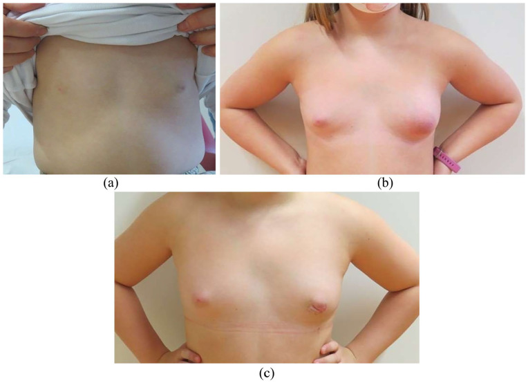 Juvenile Fibroadenoma Detected at 2 Years and Rapid Growth at Thelarche: Case Report and Literature Review.