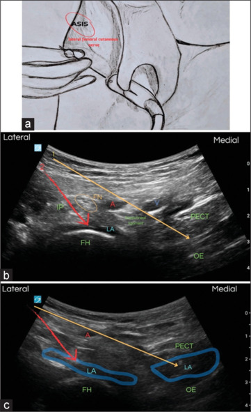 Femoral rami obturator nerve trunk (FRONT) block in intramedullary nailing surgery: A motor-sparing approach to anterior hip analgesia.