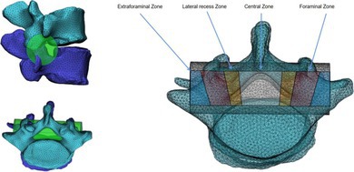 Evaluation of Indirect Decompression Effect After Extreme Lateral Lumbar Interbody Fusion Using Three-Dimensional Volumetric Measurements-A Retrospective Study.