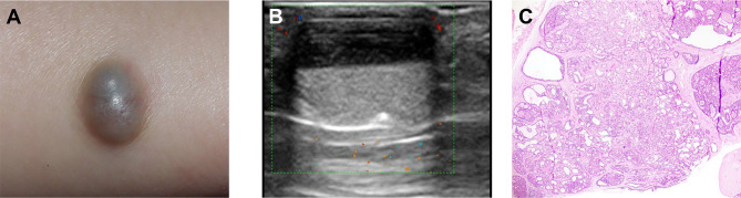 Very-High-Frequency Ultrasonographic Profiling Characteristics of Nodular Hidradenoma: A Retrospective Analysis.
