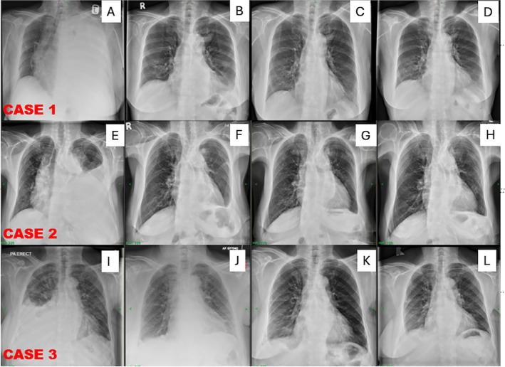 Synergistic Sealing of the Pleural Space: Combining Thoracoscopic Talc Poudrage and IPC for Malignant Pleural Effusion-A Case Series.