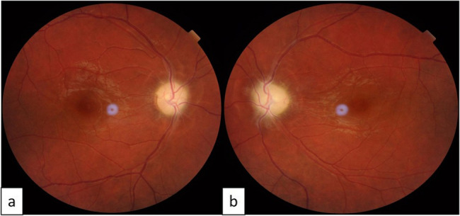 Acute bilateral vision loss secondary to cerebral venous thrombosis-induced intracranial hypertension: a case report.