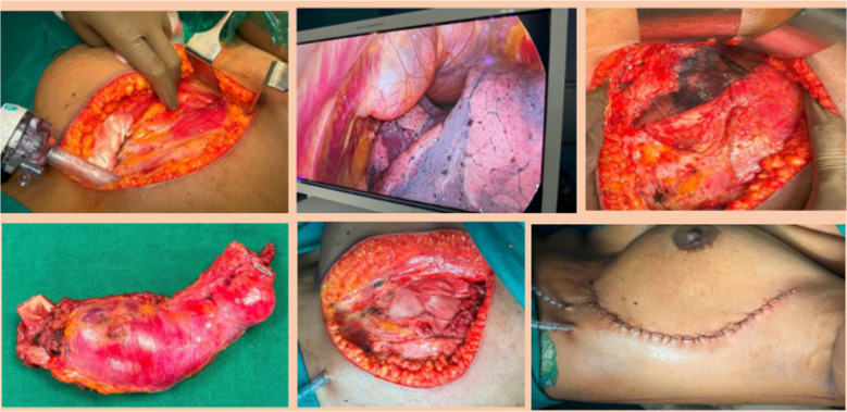 Short-term outcomes of chest wall resections.