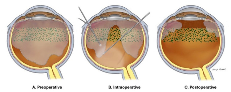 Vitrectomy as a Prevention for Retinal Detachment in High-Risk Eyes.