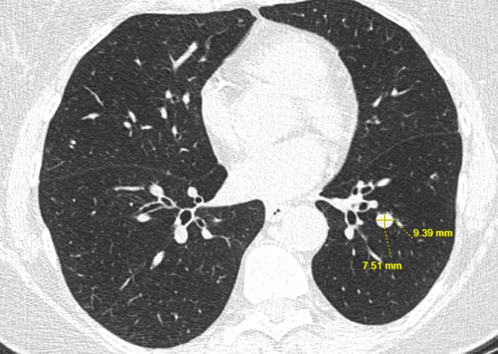 AIM (Anticipate/Adjust, Image, Manage) to Prevent Bleeding During Robotically-Assisted Bronchoscopic Ablation.
