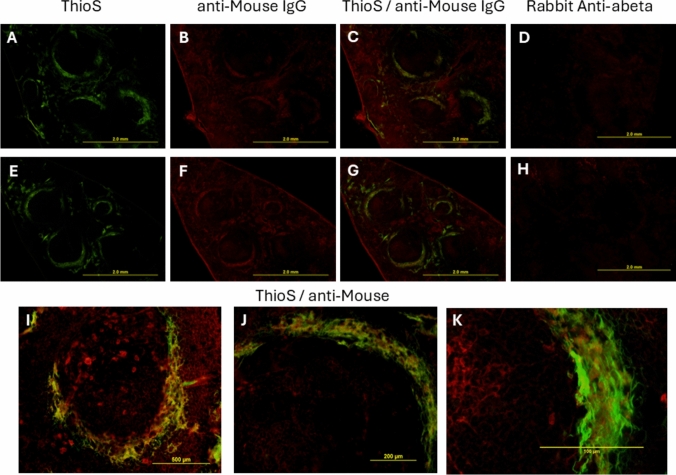 Splenomegaly, Spleen Amyloidosis and Neutrophil Infiltration are Present in 3xTg-AD, but not Tg-SwDI Mice.