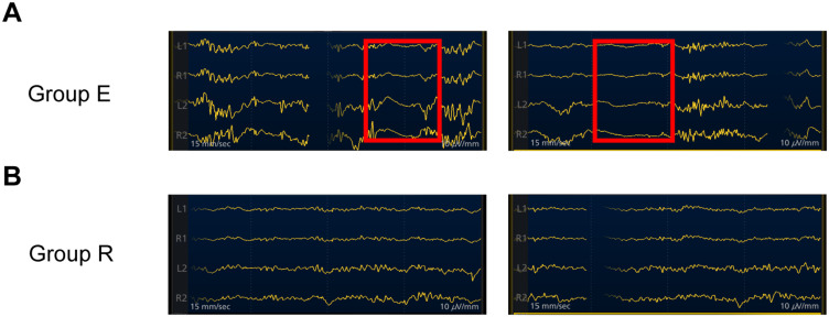 Comparison of EEG Burst Suppression and Hemodynamic Effects Between Remimazolam Tosilate and Etomidate During General Anesthesia Induction: A Retrospective Analysis.