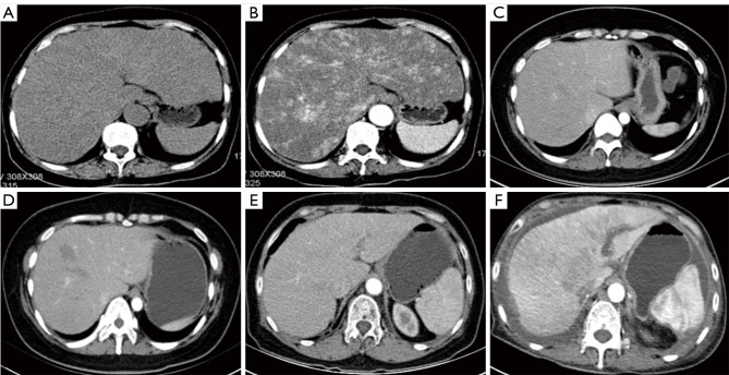 Computed tomography manifestations of drug-induced liver injury according to type and severity of injury.