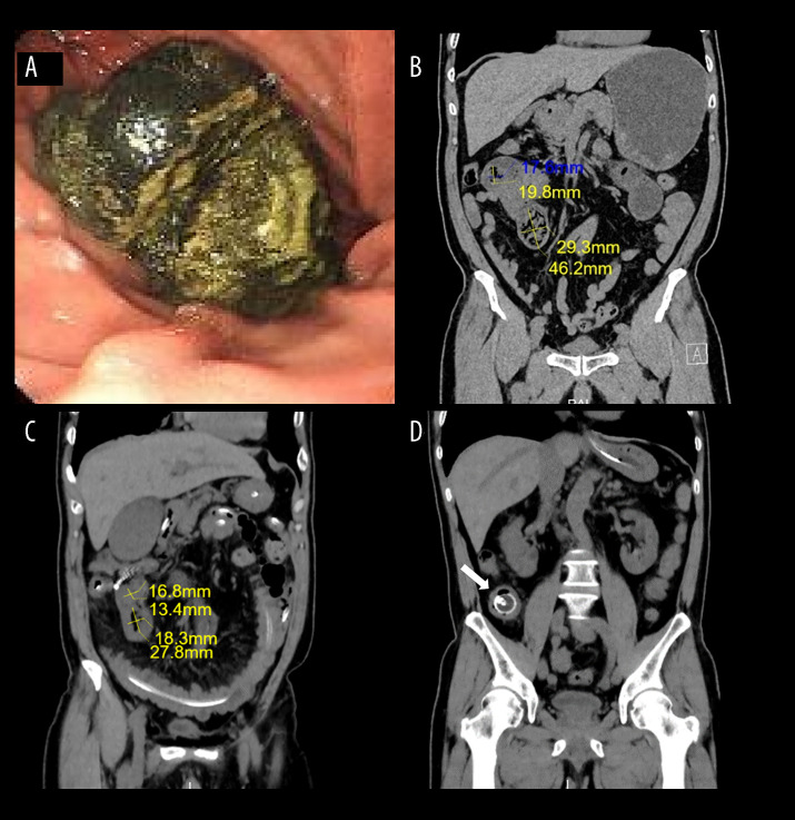 Non-Surgical Resolution of Phytobezoar-Induced Bowel Obstruction Using Sodium Bicarbonate and Catheter: A Report of 2 Cases.