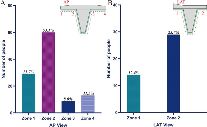 Risk Factors for Physiologic Radiolucent Lines Under the Tibial Base Plate After Osteoarthritis With Primary Computer-Assisted Navigation TKA-A Nested Case-Control Study.