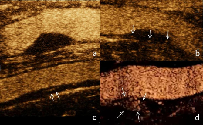 Current status and advances in ultrasound evaluation of neovascularization within carotid artery plaques: a systematic review.
